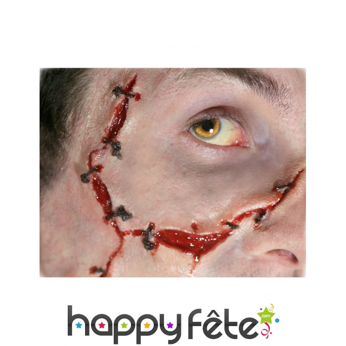 Blessure avec points de suture