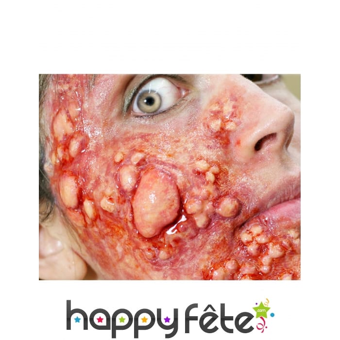 Cloques purulentes par transfert à l eau