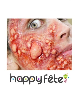 Cloques purulentes par transfert à l eau