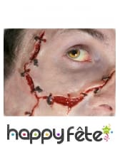 Blessure avec points de suture