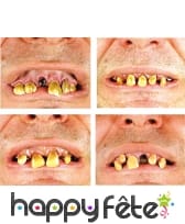 Dentier de dents abimées